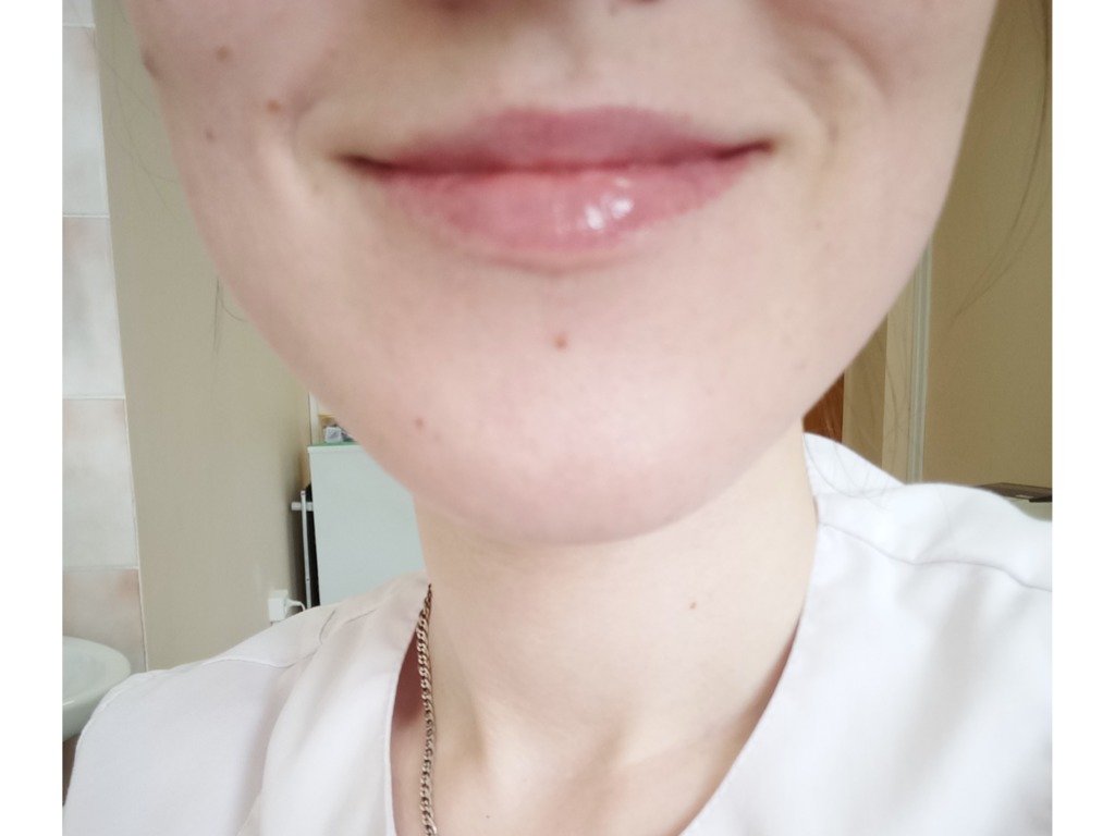 Фото 1. Почему появились ассиметрия и складка на носогубке после филлера?