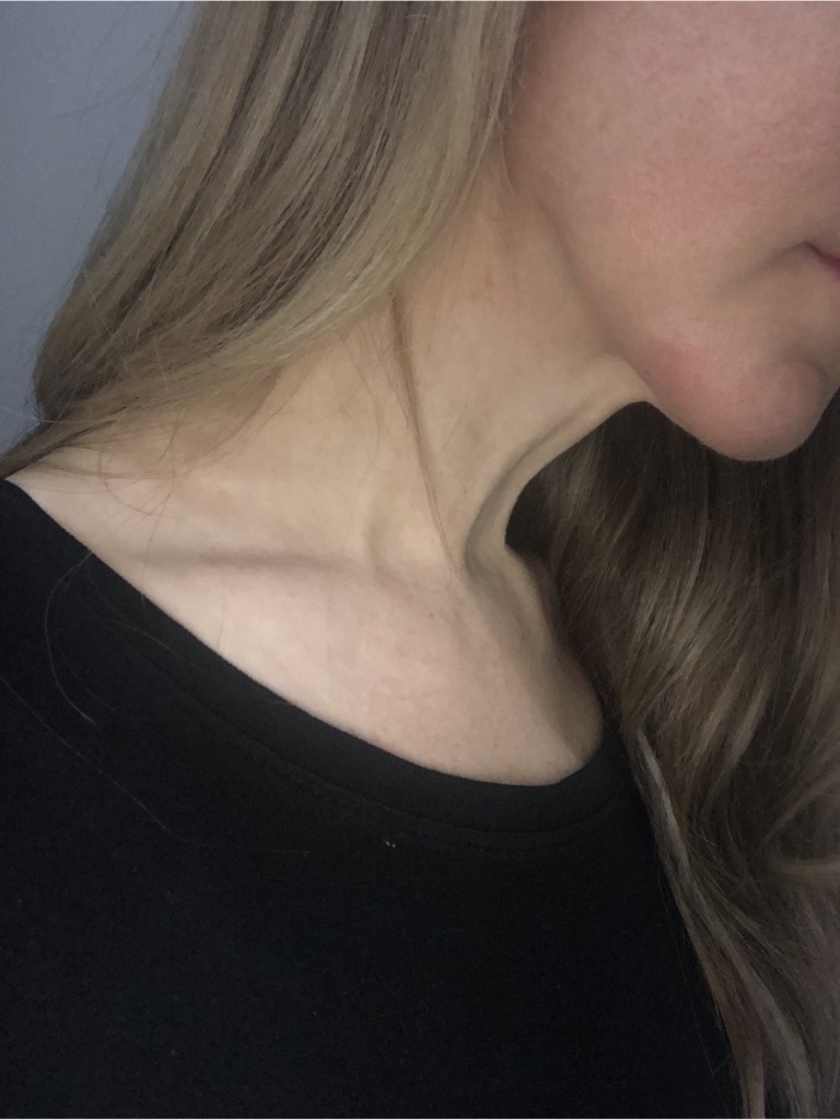 Фото 3. Каким способом можно окончательно вывести Radiesse?
