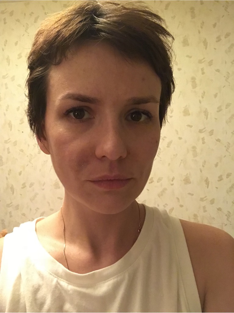 Фото 1. Такие симптомы после коррекции носогубных складок это норма?