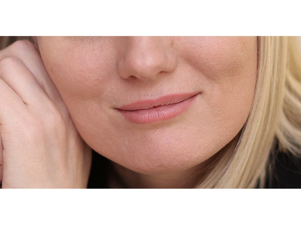 Фото 1. Почему получился такой эффект после филлера и что теперь делать?