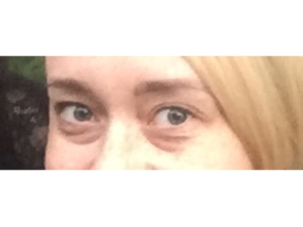 Фото 1. Можно ли коррекцией носослезной борозды филлером решить проблему мешков навсегда?