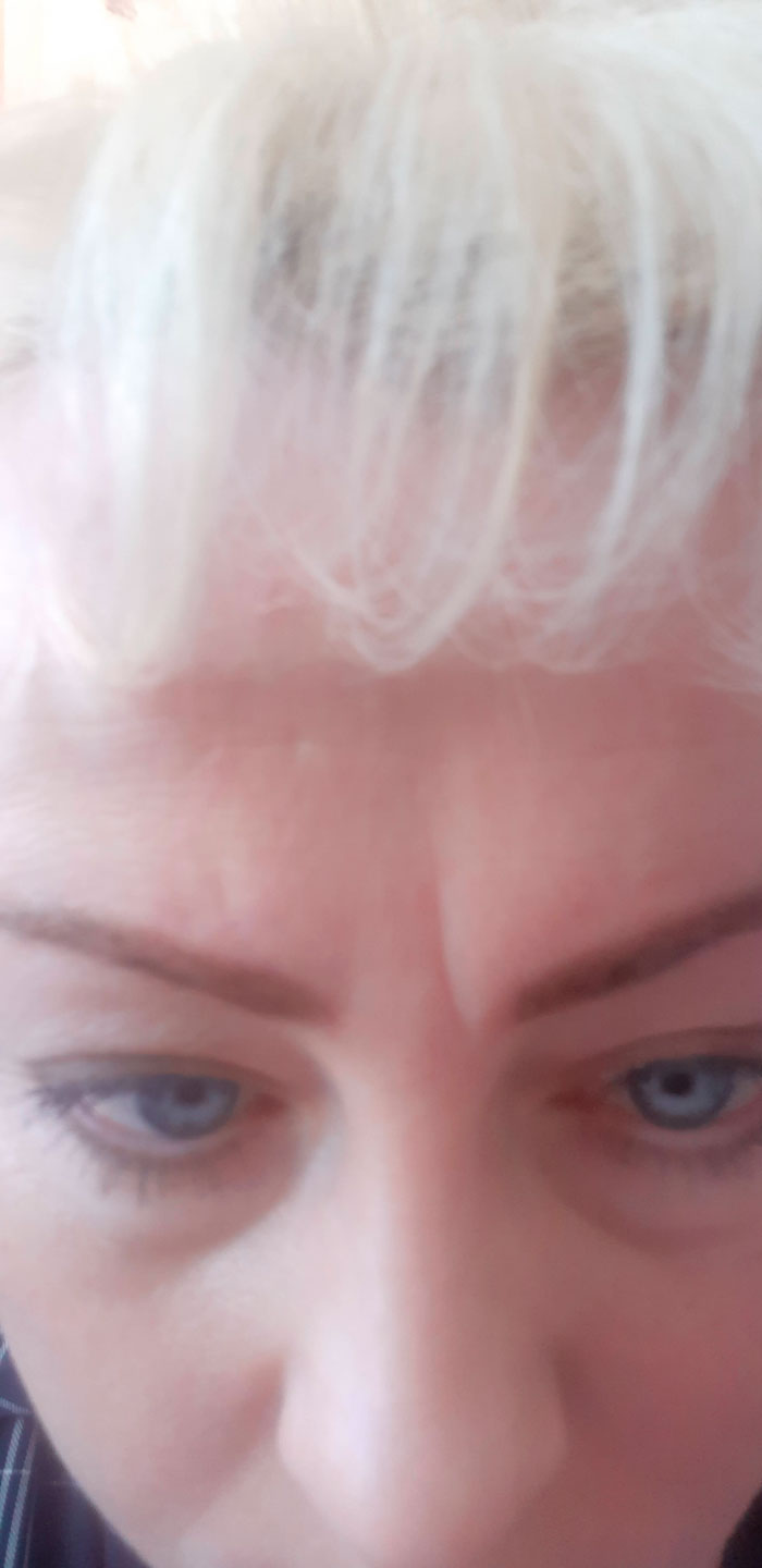 Фото 1. Каким способом можно убрать межбровный залом, если Ботокс не дал эффекта?