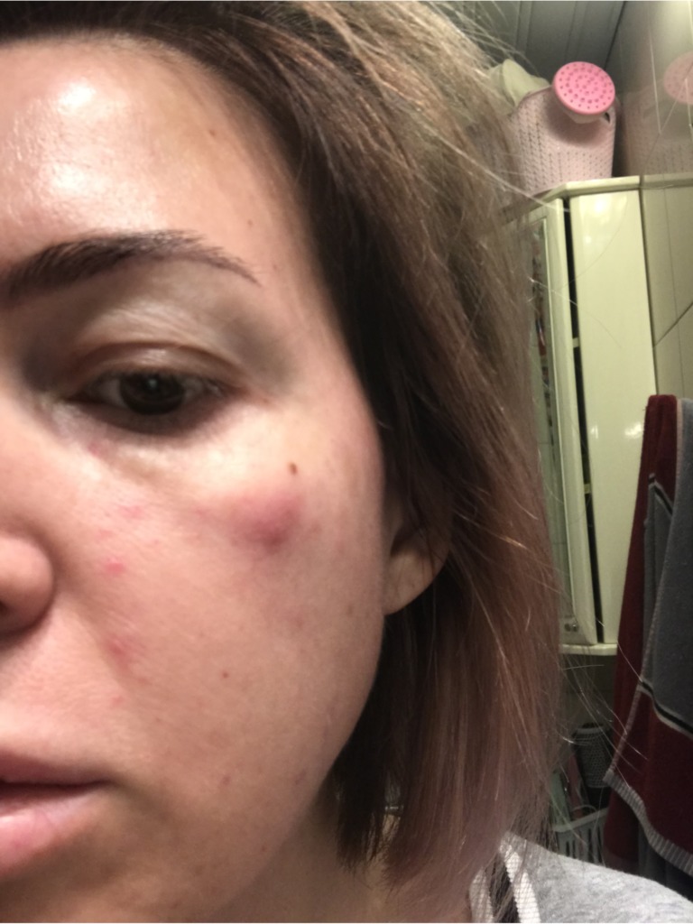 Фото 1. Если наблюдается нагноение после биоревитализации, что нужно делать?