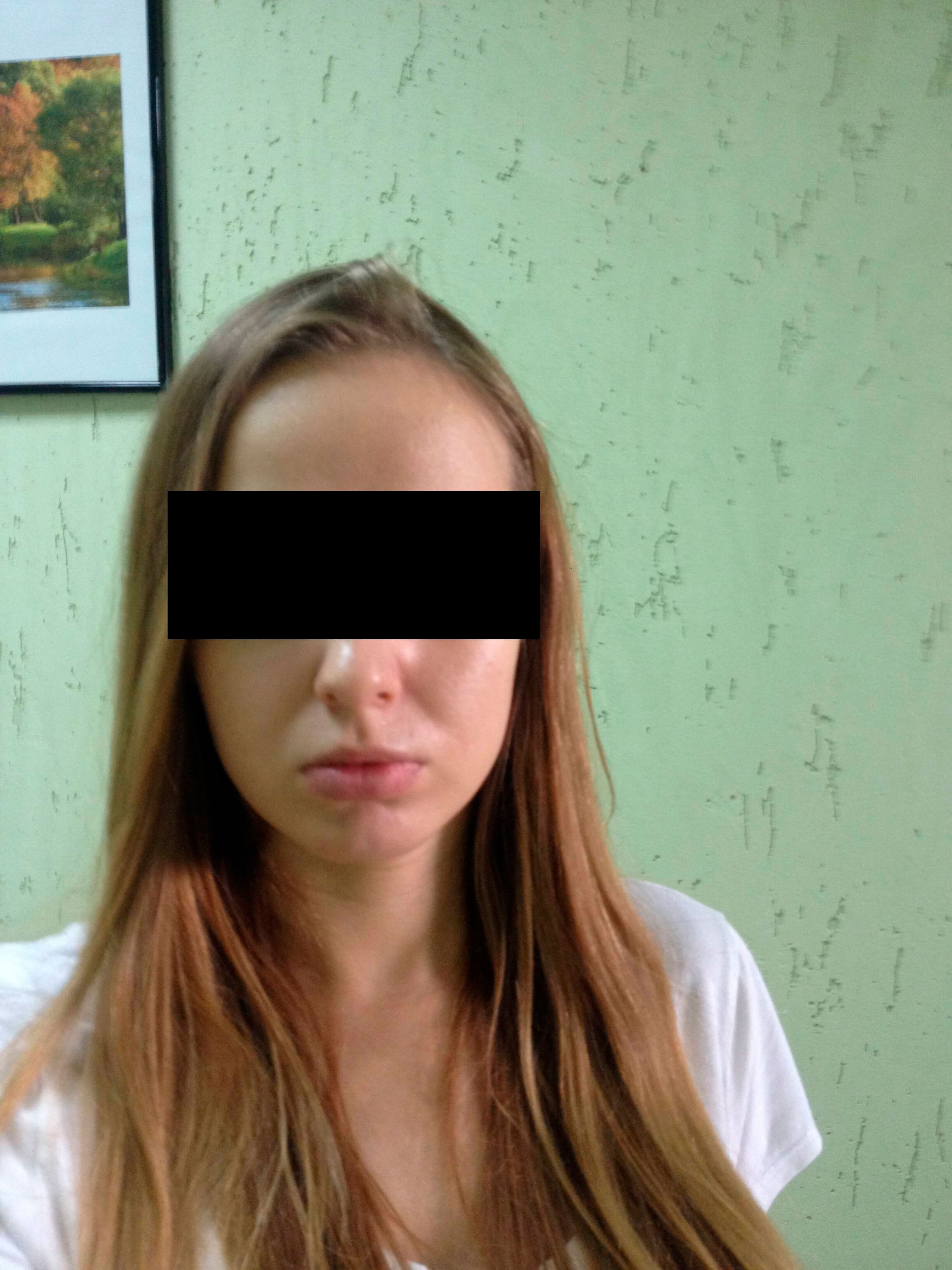 Фото 1. Как подтянуть носогубные складки?