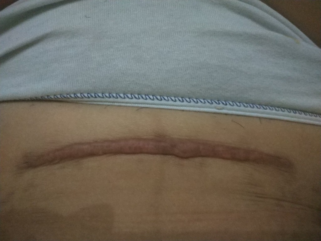 Фото 2. Что делать с келоидным рубцом, который разрастается и чешится?
