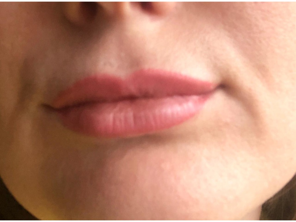 Фото 7. Почему получился такой эффект после филлера и что теперь делать?