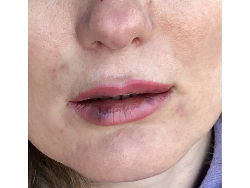 Фото 2. Почему получился такой эффект после филлера и что теперь делать?