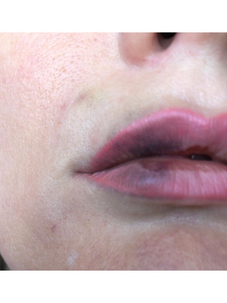 Фото 3. Почему получился такой эффект после филлера и что теперь делать?