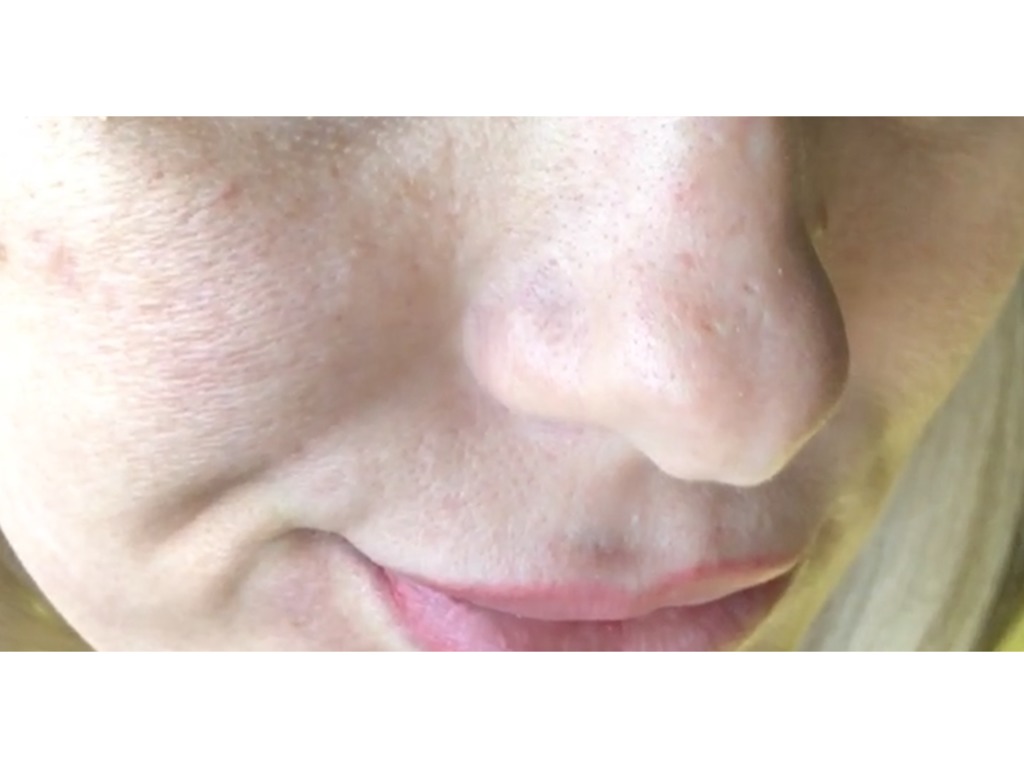 Фото 5. Почему получился такой эффект после филлера и что теперь делать?