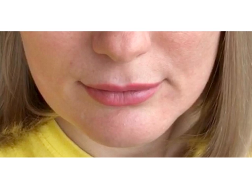 Фото 8. Почему получился такой эффект после филлера и что теперь делать?