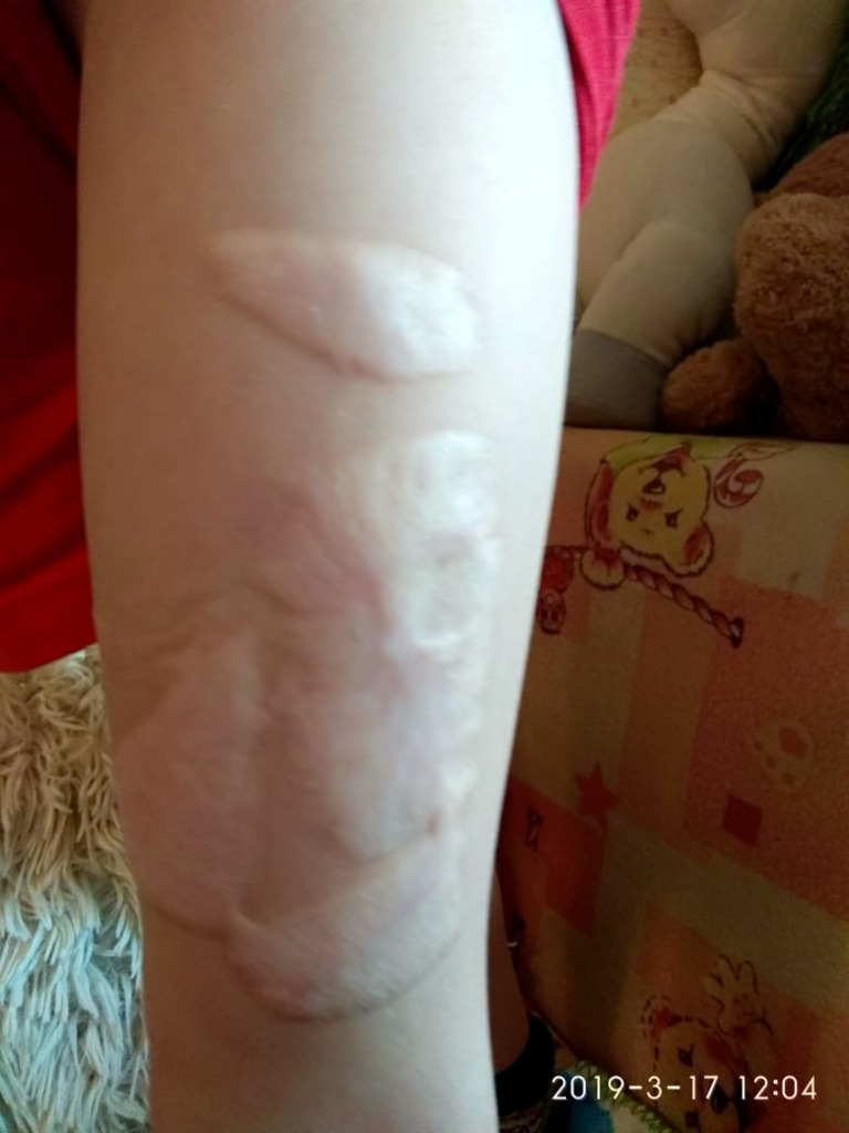 Фото 1. Есть ли показания для лазерной шлифовки ребенку в данном случае?