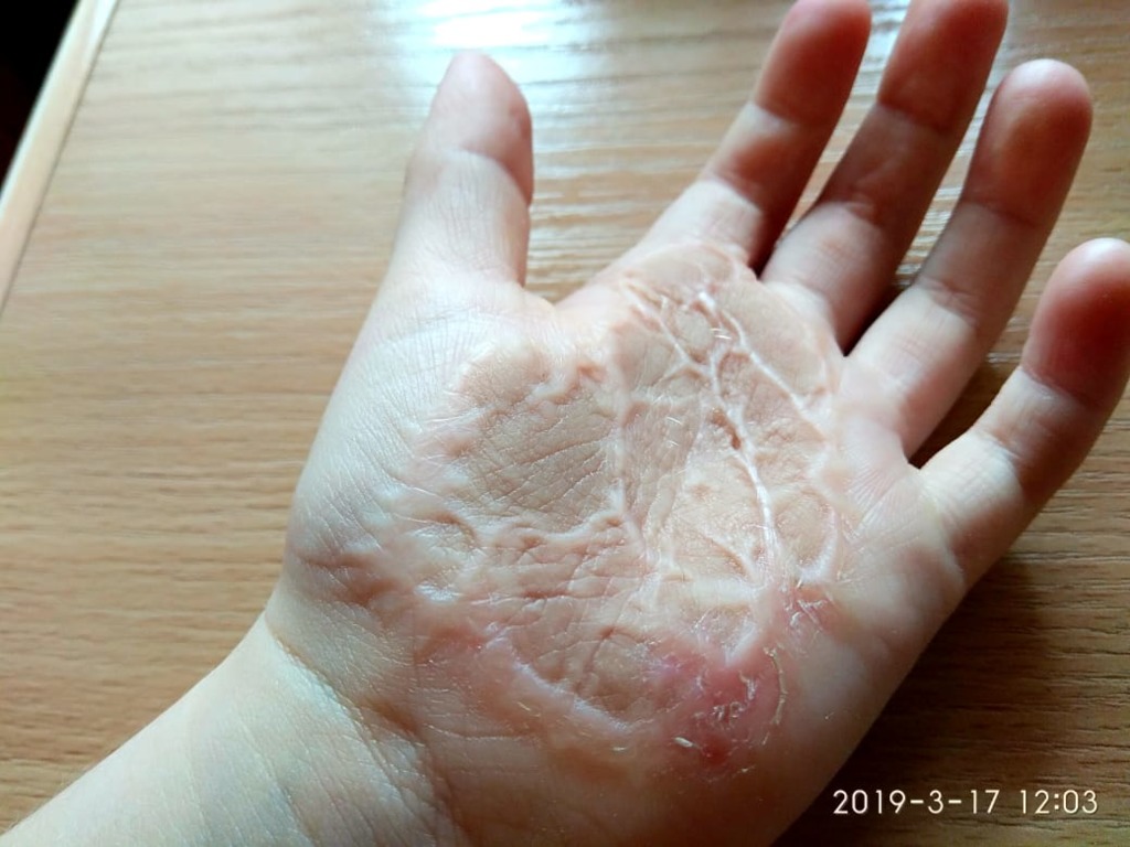 Фото 2. Есть ли показания для лазерной шлифовки ребенку в данном случае?