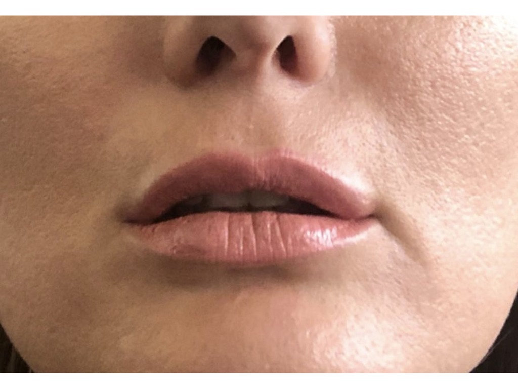 Фото 4. Почему получился такой эффект после филлера и что теперь делать?