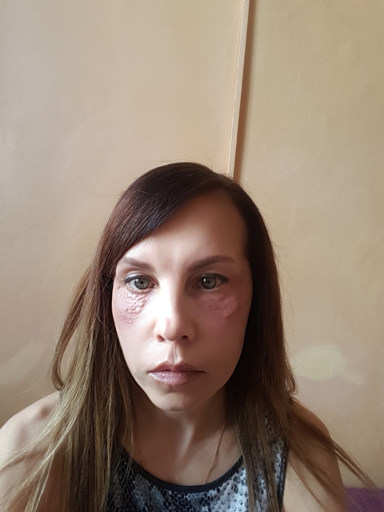 Фото 3. Что предпринять, чтобы рассосать папулы после мезотерапии вокруг глаз?