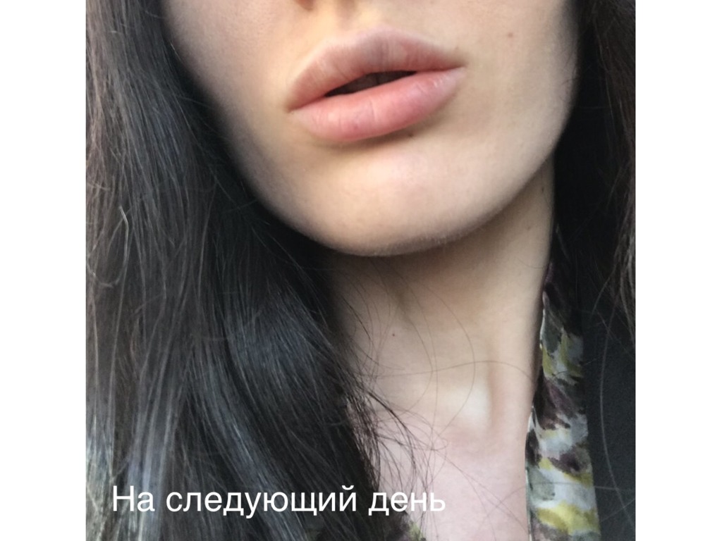 Фото 3. Что предпринять в ситуации, если постоянно отекает губа после филлера?