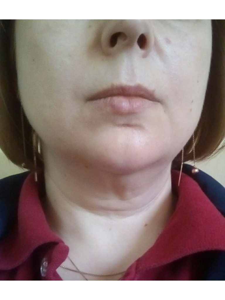 Фото 1. Как можно восполнить объем объем на лице после похудения?