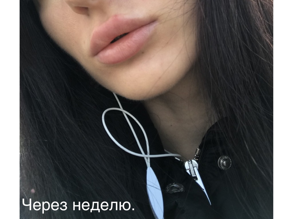 Фото 4. Что предпринять в ситуации, если постоянно отекает губа после филлера?