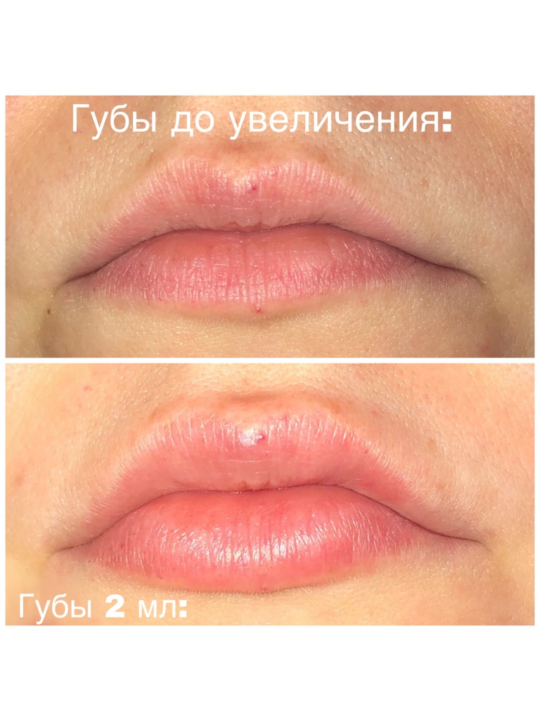 Фото 1. Почему нет эффекта от филлеров?