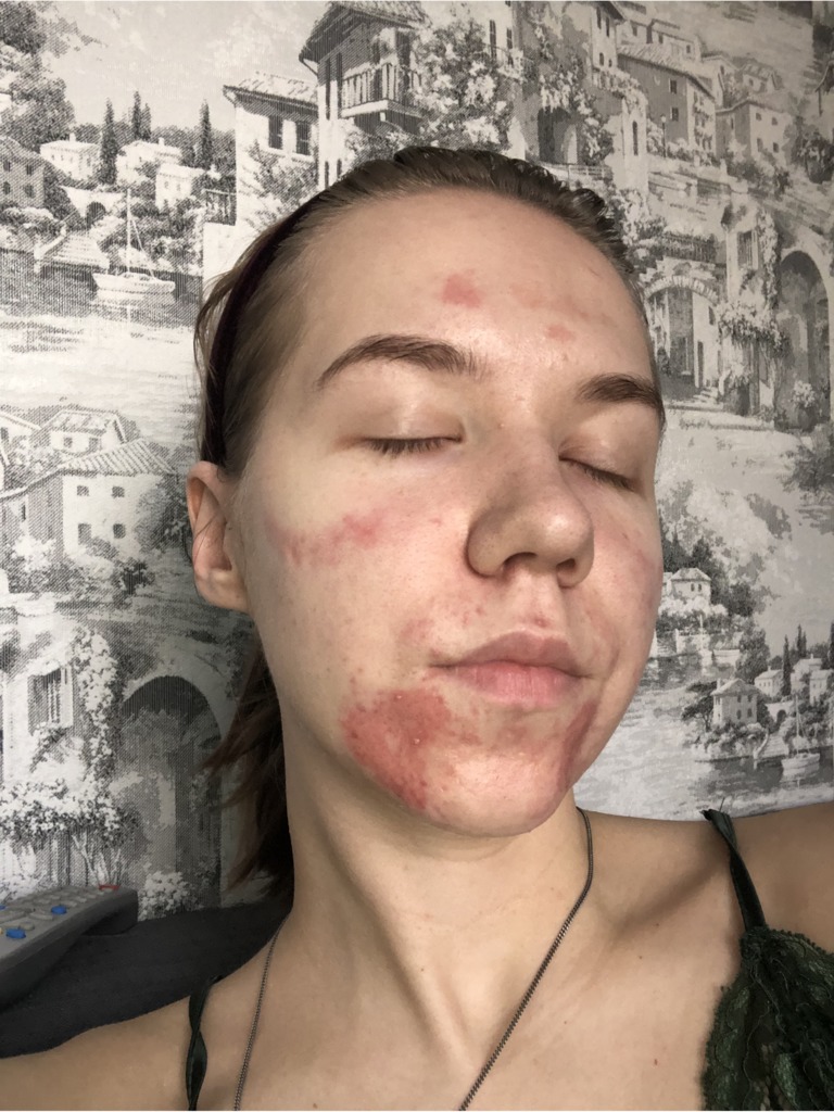 Фото 2. Как убрать образовавшиеся красные пятна?