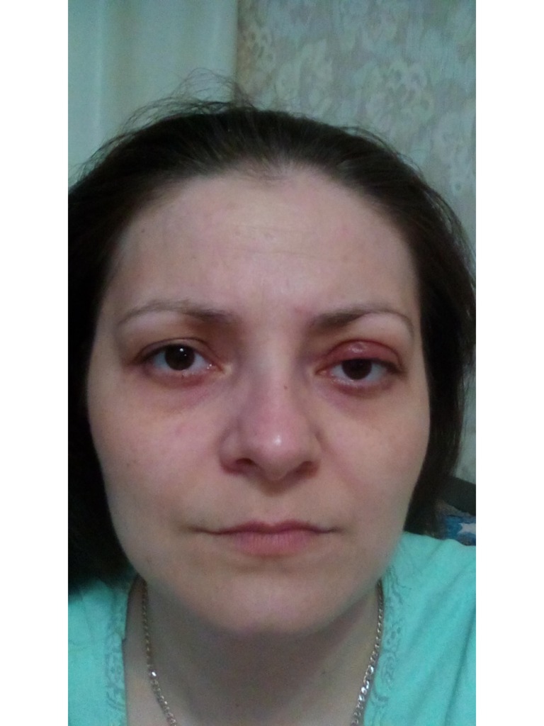 Фото 1. Что нужно делать мне как пациенту, чтобы избежать ассиметрии после блефаропластики?