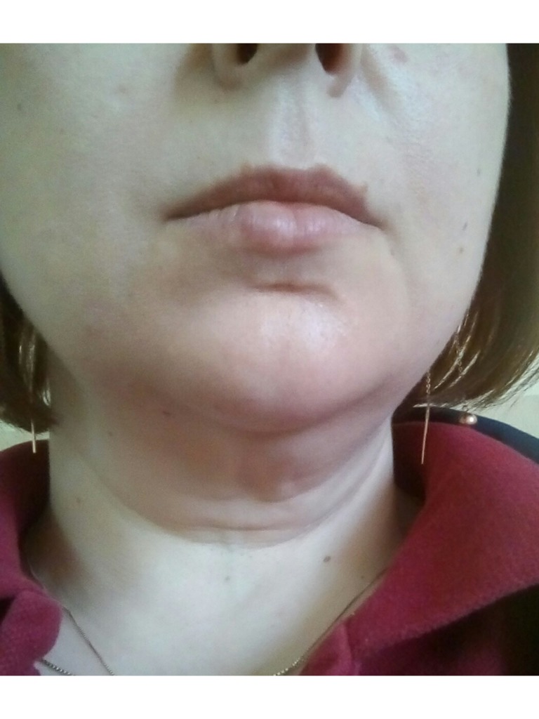 Фото 2. Как можно восполнить объем объем на лице после похудения?