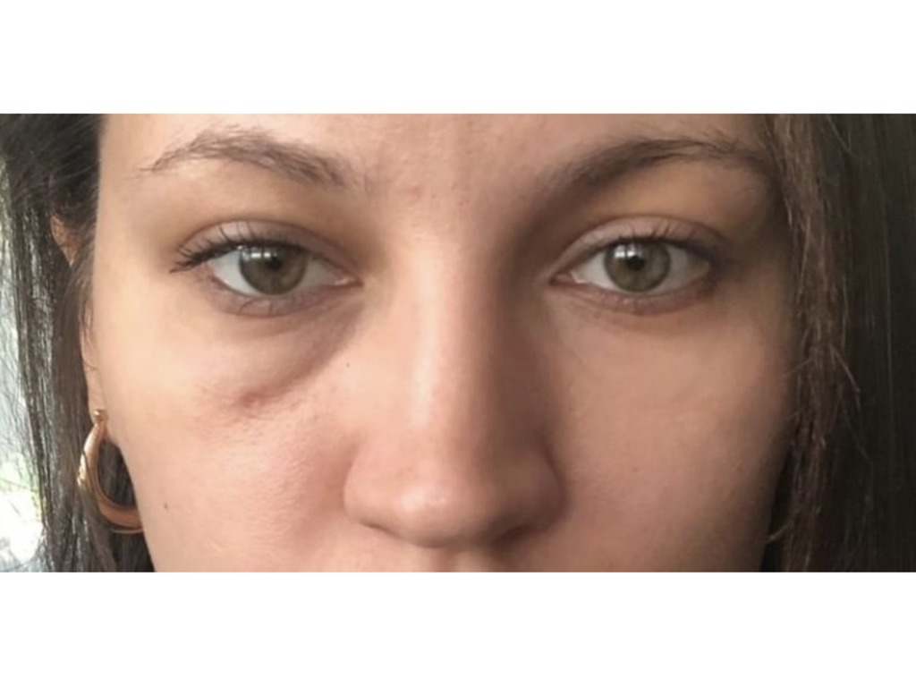 Фото 1. Что делать, если после филлера с одной стороны под глазом отек?