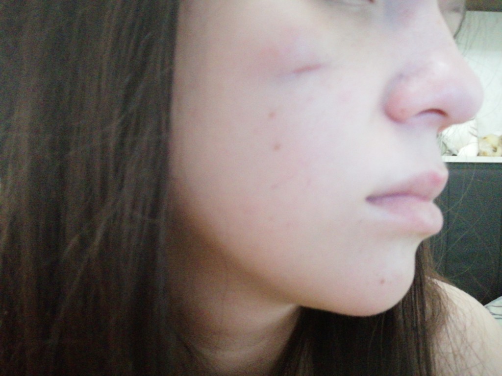 Фото 1. Как лечить образовавшийся рубец?