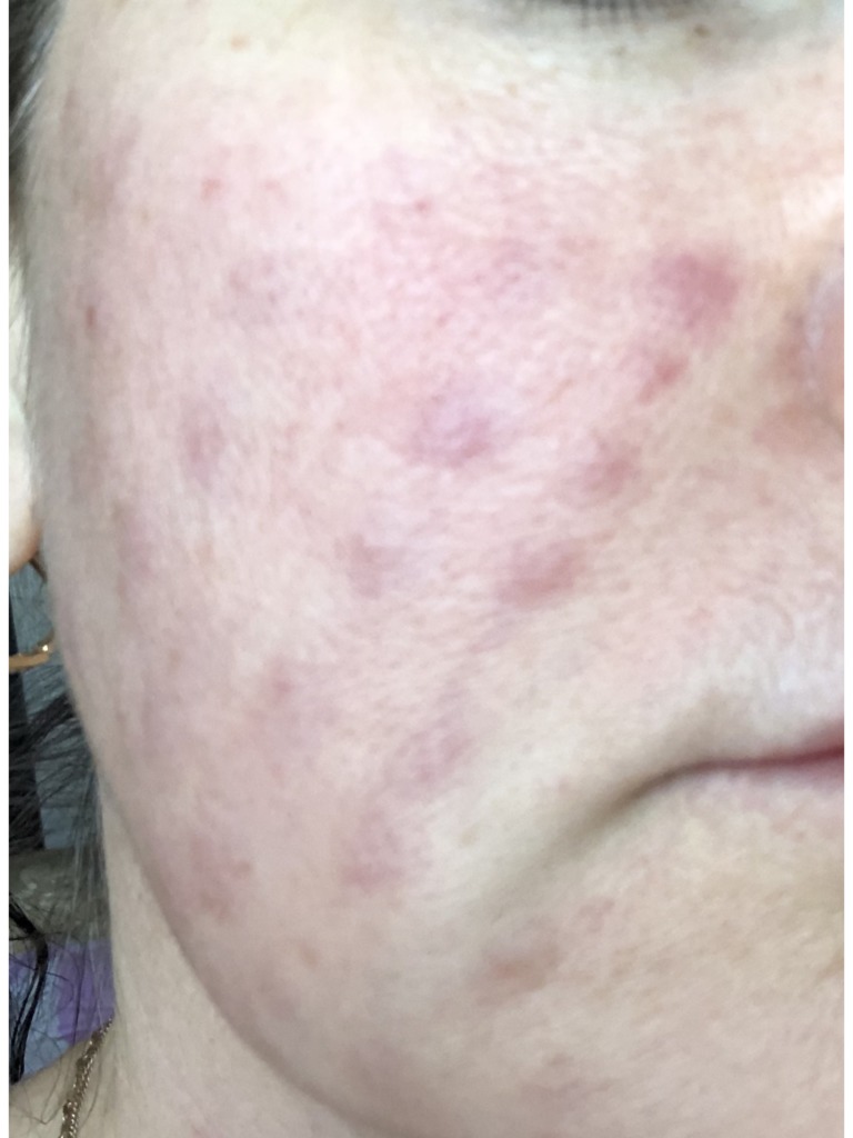 Фото 1. Что делать, если не сходят папулы после биоревитализации?