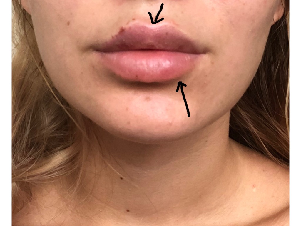 Фото 1. Какие действия предпринять, чтобы не осталось комков после увеличения губ?