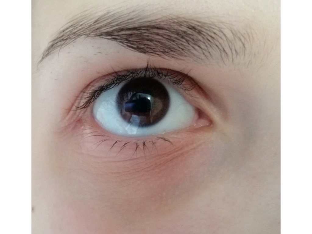 Фото 1. Что нужно делать, чтобы убрать морщины под глазами?