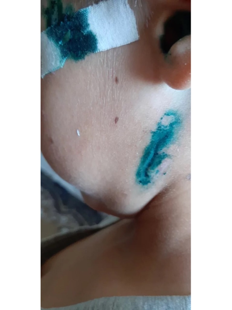 Фото 1. Какие мази можно использовать, чтобы предотвратить образование рубцов при заживлении?