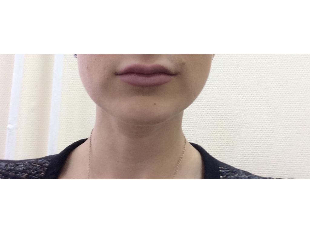 Фото 1. Пройдут ли белые круги над губой после увеличения филлером?