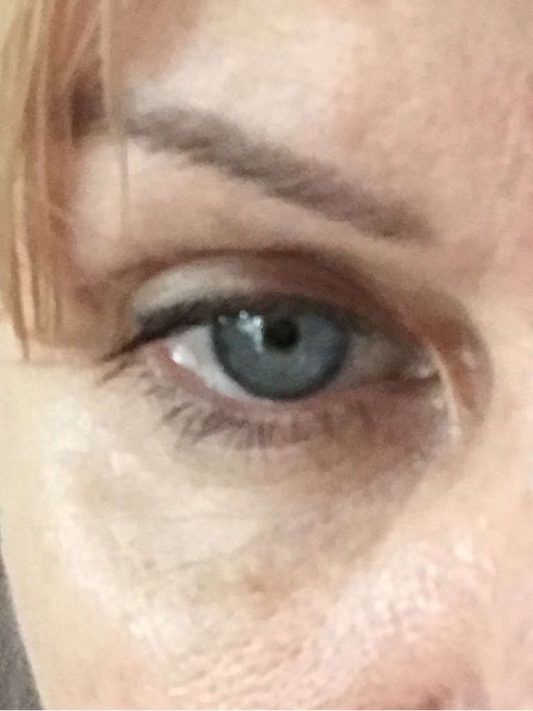 Фото 1. Возможно ли избавиться от эпикантуса без повторной операции?