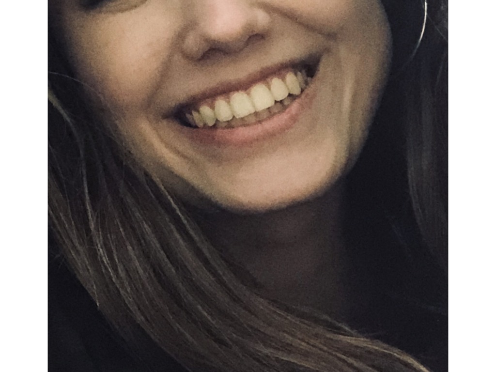 Фото 2. Как сделать так, чтобы губа при улыбке не задиралась?