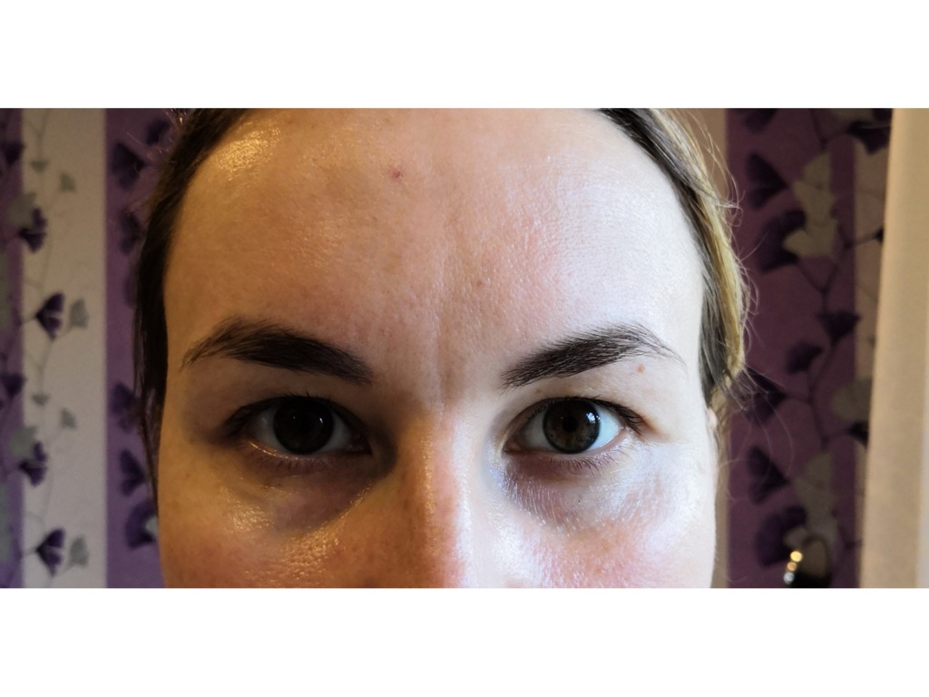 Фото 2. Что сделать, чтобы разгладить межбровье?