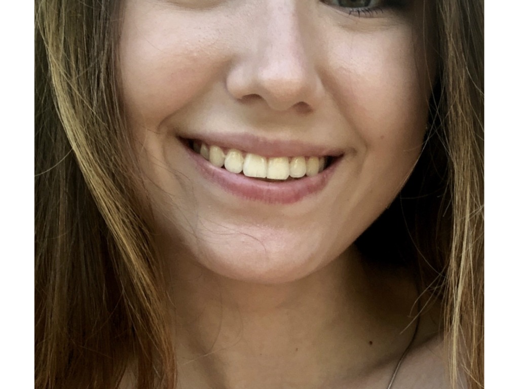 Фото 3. Как сделать так, чтобы губа при улыбке не задиралась?