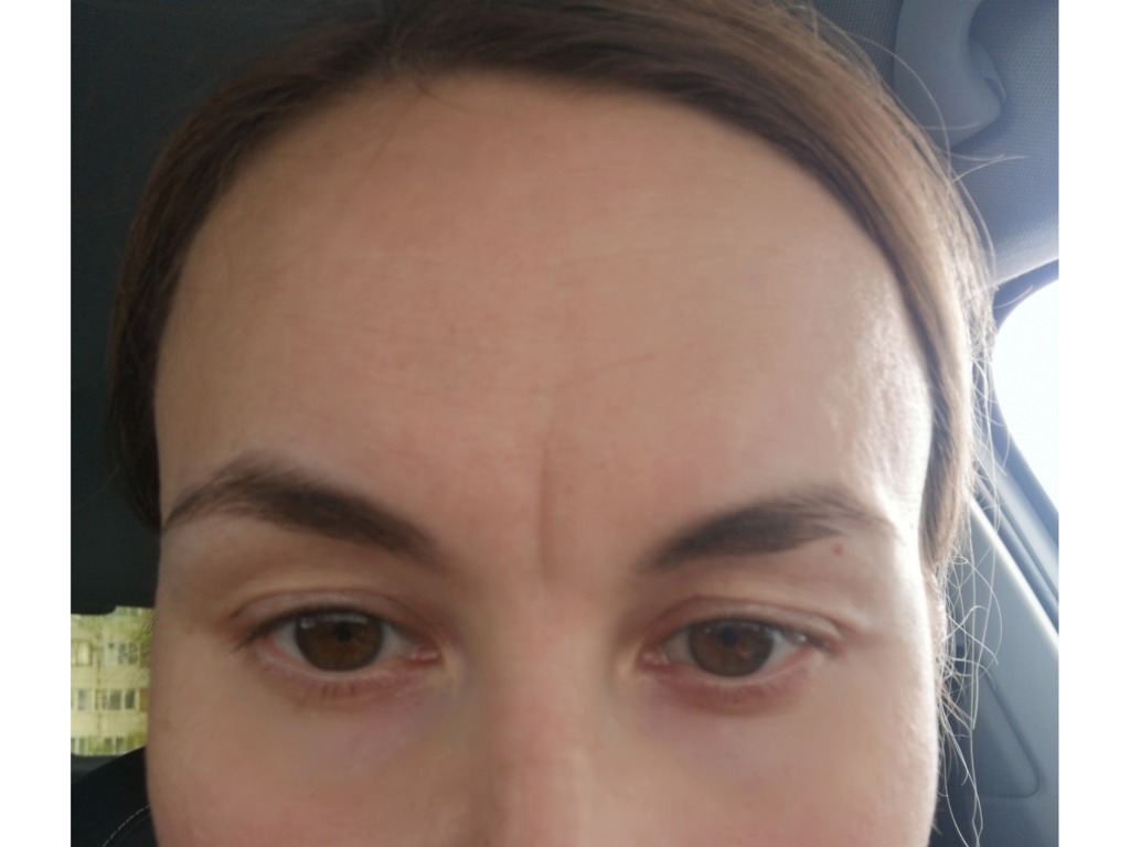 Фото 1. Что сделать, чтобы разгладить межбровье?