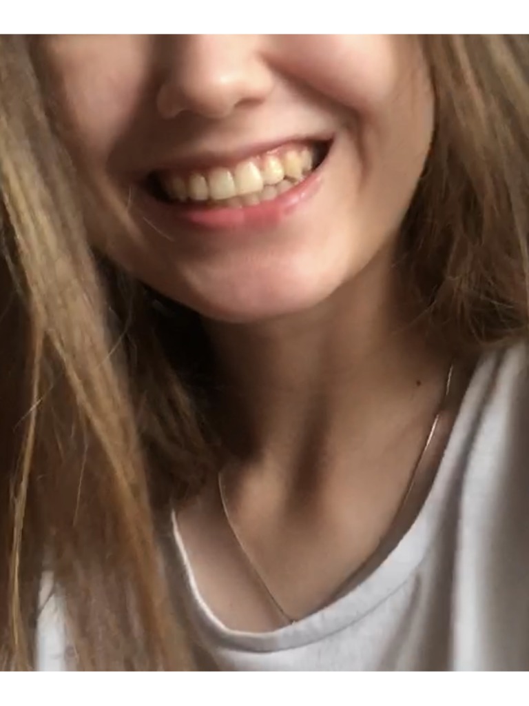 Фото 1. Как сделать так, чтобы губа при улыбке не задиралась?
