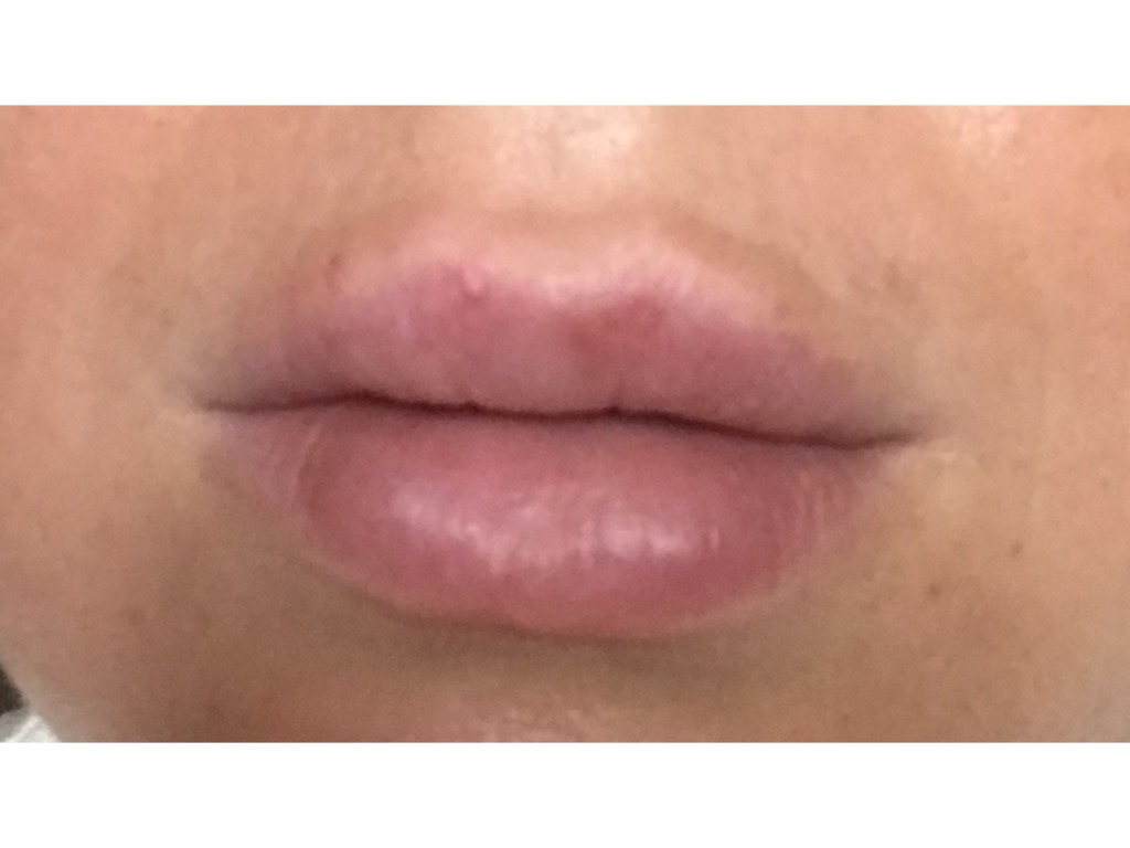 Фото 1. Как убрать филлер, если он выходит за красную кайму губ?
