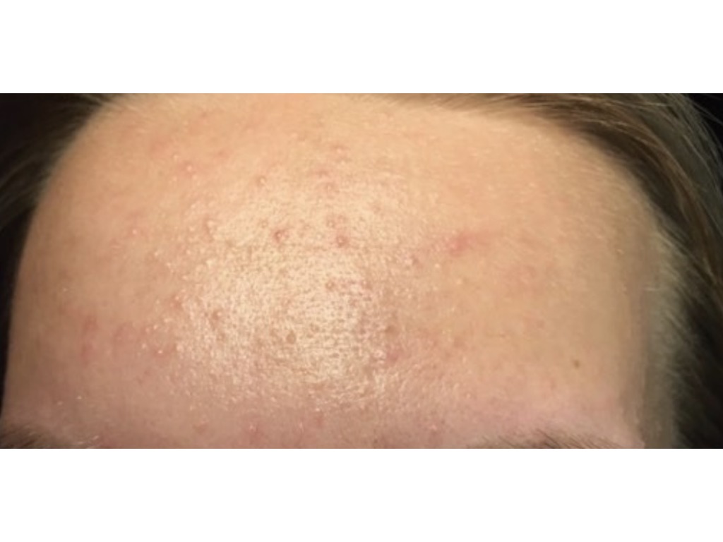 Фото 1. Можно ли продолжать мезотерапию, если воспалились высыпания?