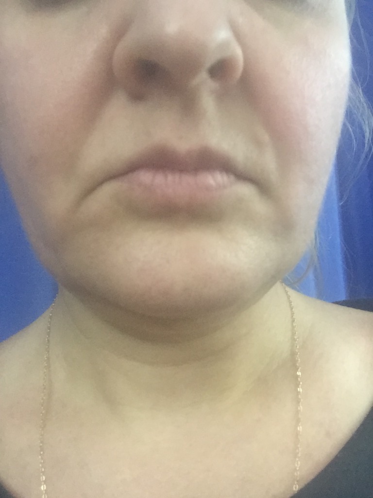 Фото 1. Как поднять уголки рта?