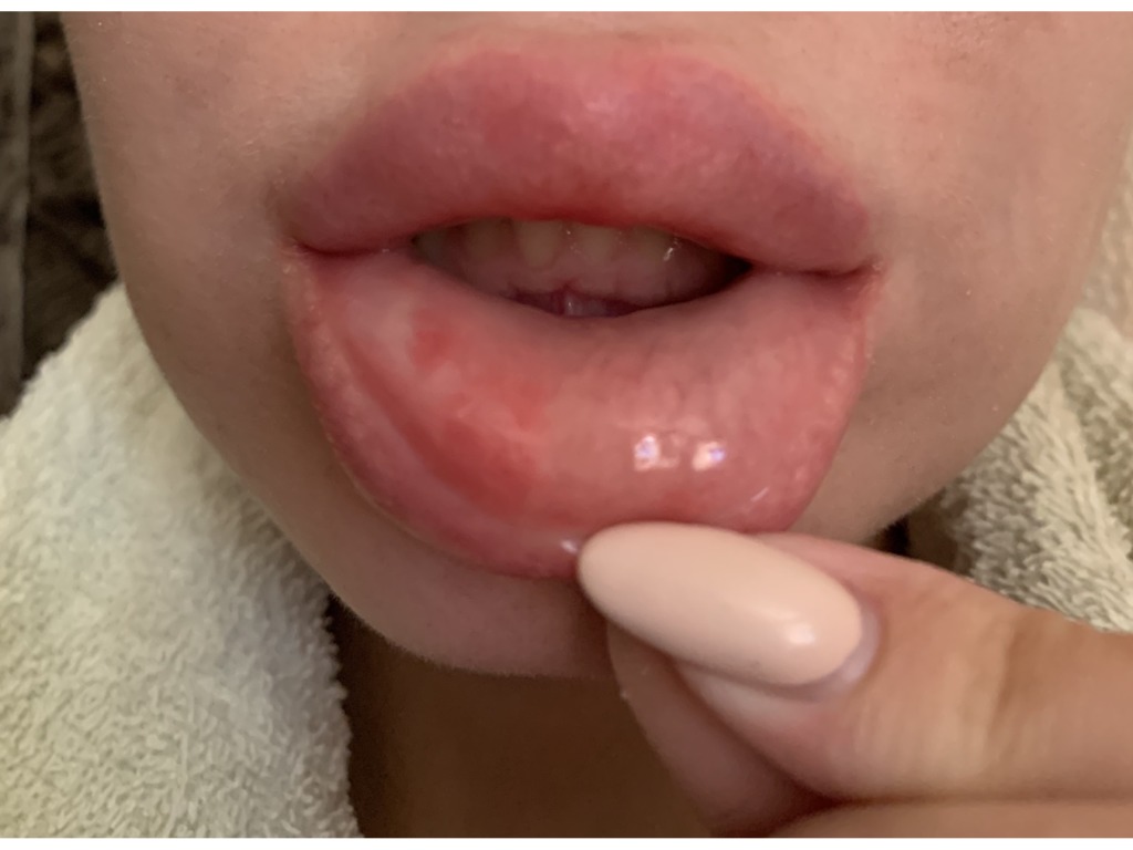 Фото 1. Может ли филлер препятствовать заживлению?