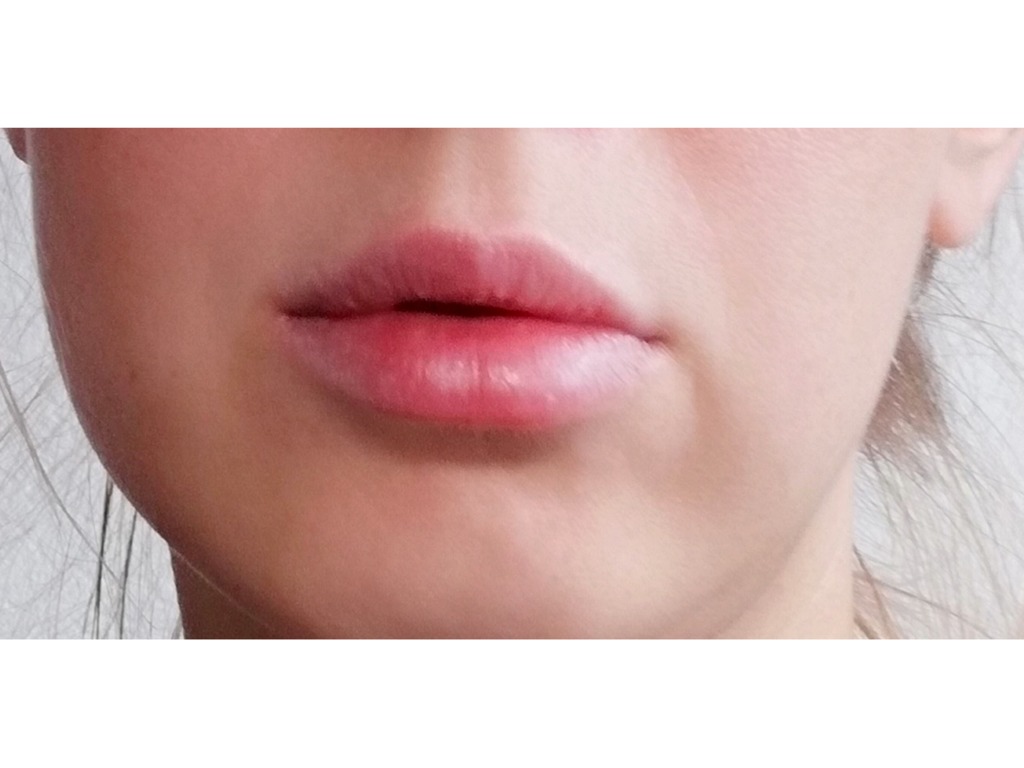 Фото 1. Безопасно ли удалять филлер из губ лидазой?