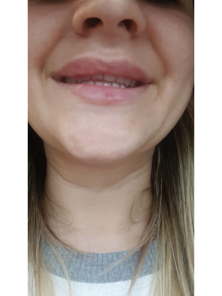 Фото 1. Рассосутся ли шишки после ювидерм?