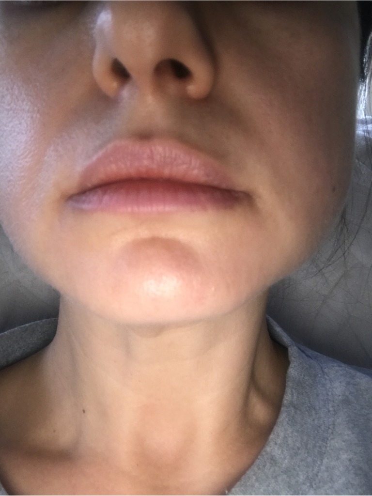 Фото 1. Такие симптомы это аллергия, воспаление или иммунная реакция на филлер?