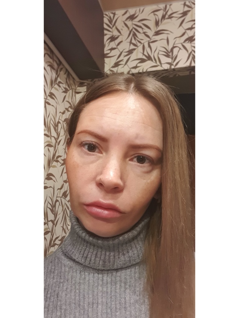 Фото 2. Как избавиться от отеков после Аквашайна?