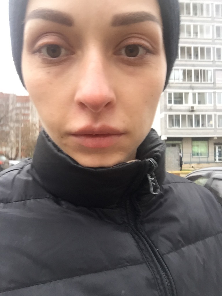 Фото 1. Решает ли проблему грыж блефаропластика?