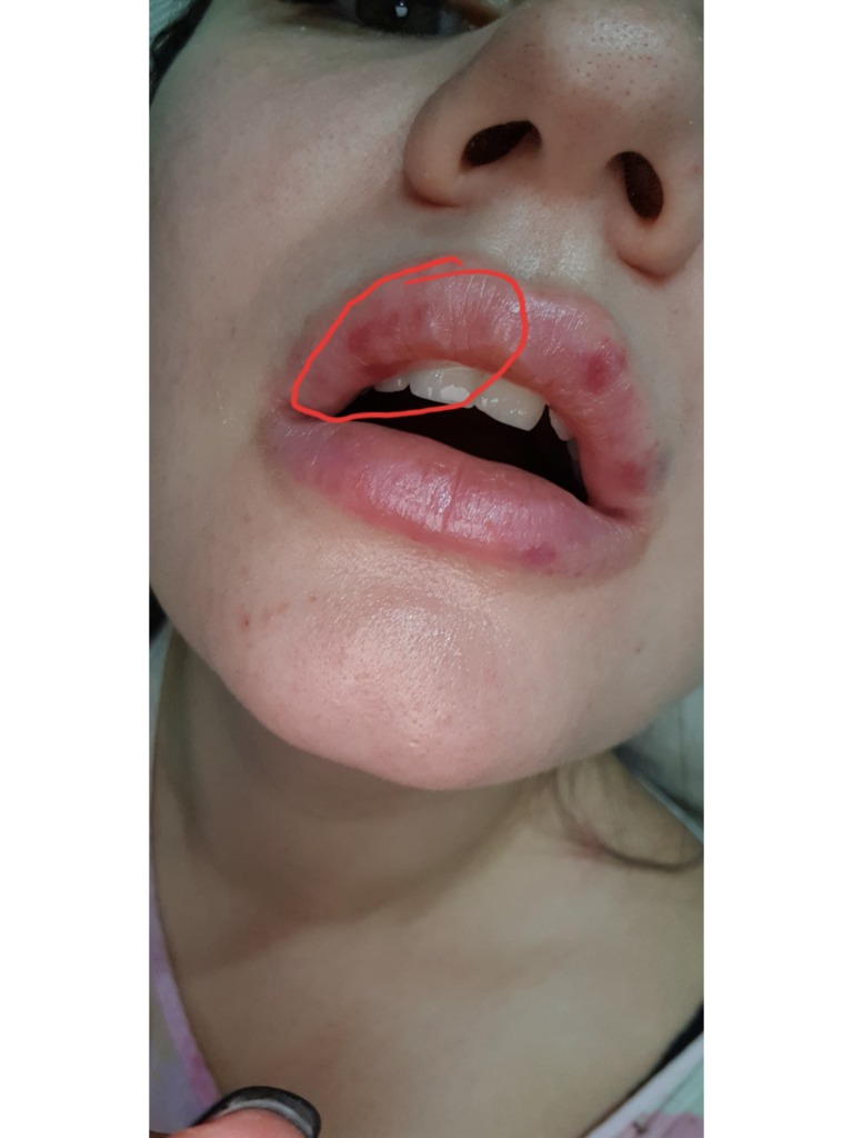 Фото 1. Нужно ли убирать комки или они пропадут сами?