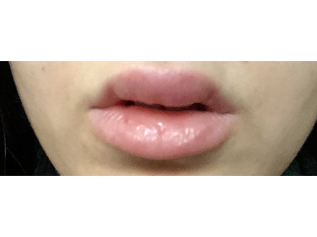 Фото 1. Можно ли вывести филлер во время беременности?