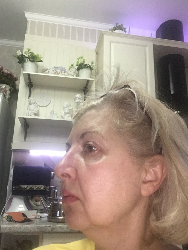 Фото 1. Подтянется ли контур лица за счет нитей?